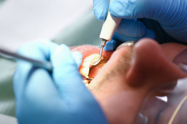 Best Emergency Treatment for Dental Infections or Abscesses in Mount Hope, NJ