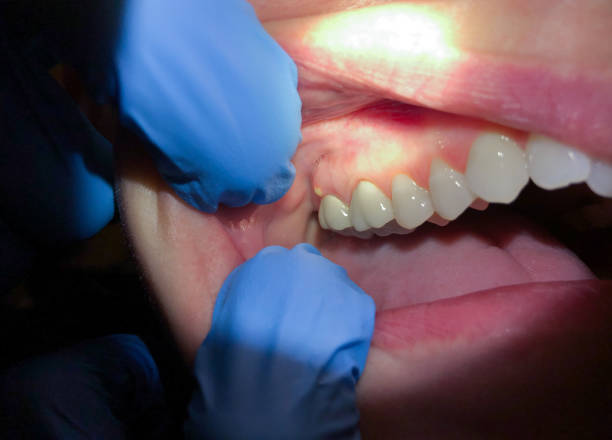 Best Emergency Dental Care for Broken or Chipped Teeth in Mount Hope, NJ
