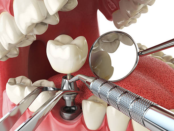 Best Emergency Root Canal Treatment in Mount Hope, NJ